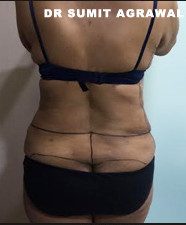 Clinic Liposuction