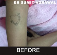 Laser Tattoo removal