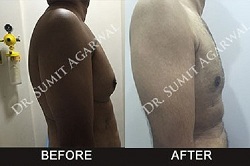 Gynecomastia Treatment