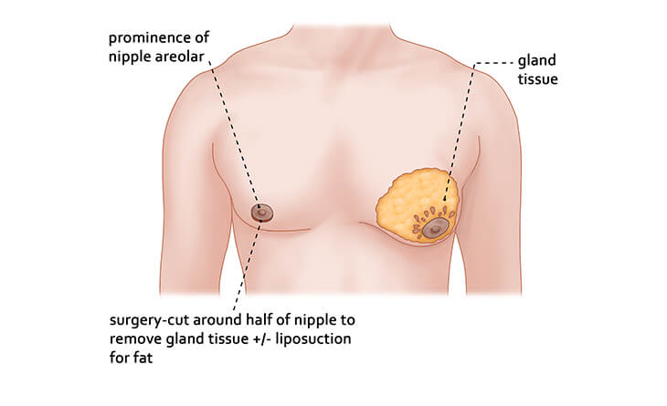 gynecomastia